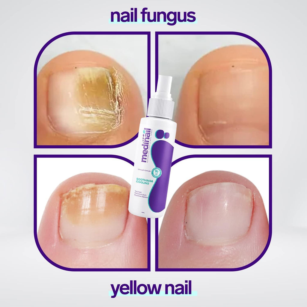 Jaysuin - Nail Fungus Spray (Original)